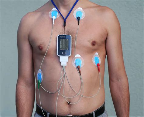 Sticky patches (electrodes) are placed on the chest and sometimes the arms and legs. . Itchy rash from holter monitor